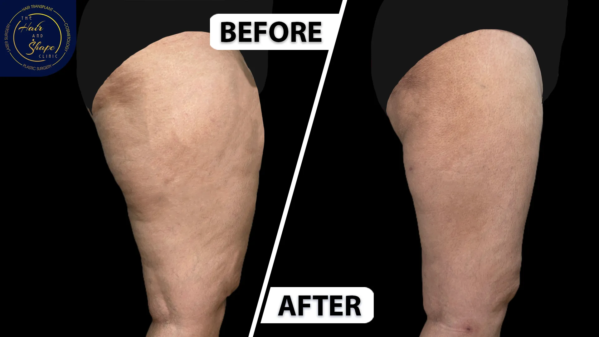 Thigh Liposuction result5